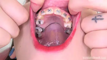 Brunette with Braces Opens Wide for the Camera